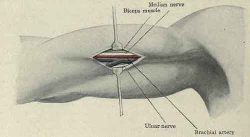 Fig. 286.   Ligation of the brachial artery in the middle of the arm showing the median nerve lying on the artery and the ulnar nerve to its inner side.