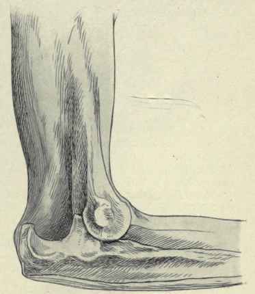 Fig. 306.   Posterior luxation of the elbow, showing the position of the bones as viewed from the inner side.