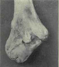 Fig. 312.   Fracture of internal condyle and trochlea, causing gun stock deformity (cubitus varus). From a photograph of a preparation in the Mutter Museum of the College of Physicians.