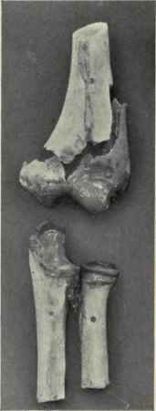 Fig. 313.   Intercondylar or T fracture of the lower end of the humerus. Mutter Museum, College of Physicians.