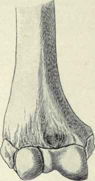 Fig. 315.   Epiphysis of the lower end of the humerus; unites with the shaft at about the seventeenth or eighteenth year.