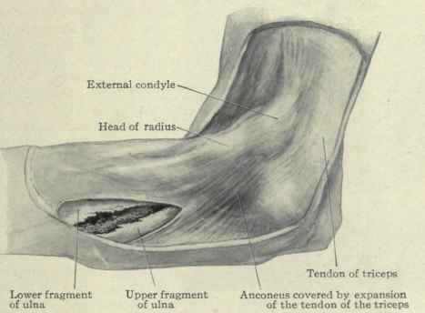 Fig. 335.   Fracture through the upper third of the ulna viewed from the outer side.