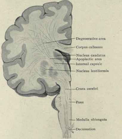 Fig. 34.   Showing the degenerative and apoplectic areas of the brain and the course pursued by the motor fibres from the cortex, through the internal capsule, crura, pons, and medulla to the decussation, where they cross the median line to supply the opposite side of the body.