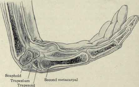 Fig. 343.   Position assumed by the carpal bones in flexion of the wrist.