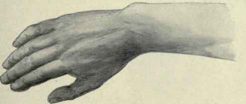 Fig. 354.   Colles's fracture of the radius, showing inclination of hand toward the radial side and prominence of the styloid process of the ulna. (From author's sketch).