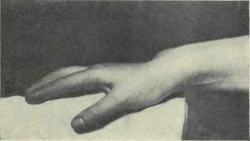 Fig. 357.   Subluxation of the wrist from disease.