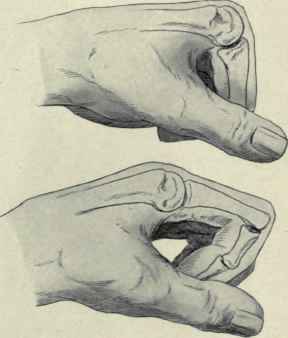 Fig. 366.   Showing how, when the fingers are flexed, the prominence of the knuckles is formed by the projection of the proximal bone.