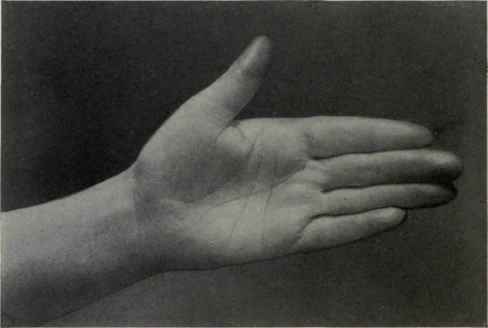 Fig. 369.   The palmar surface of the hand showing thenar and hypothenar eminences and creases.