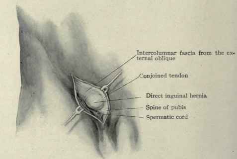 Fig. 400.   Direct inguinal hernia.