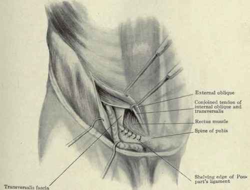 Fig. 402.   Radical cure of direct inguinal hernia. The aponeurosis of the external oblique has been divided and drawn back. The conjoined tendon has been drawn upward toward the median line. The transversalis fascia covering the rectus has been incised and the edge of the muscle has been drawn out and down and sewed to the edge of Poupart's ligament (Bloodgood). The operation is completed by sewing the conjoined tendon to Poupart's ligament, replacing the cord on it, and stitching the edges of the external oblique together down to the external ring.