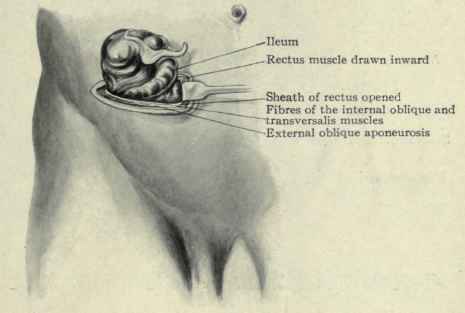 Fig. 436.   Author's incision for appendicitis. The caecum has been lifted out of the wound, bringing with it the appendix.