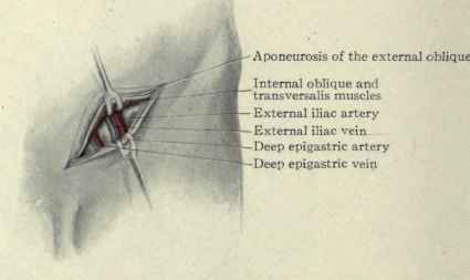 Fig. 443.   Ligation of the external iliac artery.