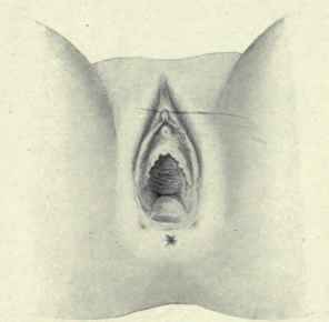 Fig. 468.   Rupture of the perineum. The vulva gapes, showing the rectum bulging forward; the two dimples, one on each side of the anus, are caused by the retracted muscles.