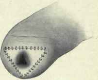 Fig. 471.   Amputation of the penis. Mucous membrane of urethra everted, cut in triangular form and sewed to the skin to avoid cicatrical contraction. (Author's method).