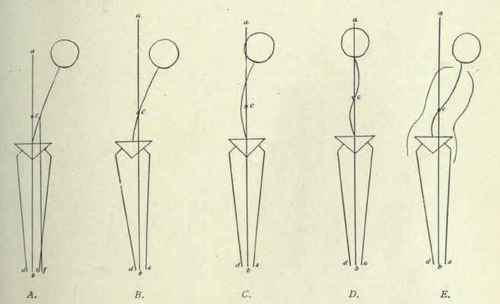 Fig. 496.   Deviation of the spine above the sacrum.