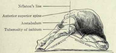 Fig. 502.   Innominate bone, resting on its inner side, to show the wedge shaped formation of its outer sur. face. The apex of the wedge is Nelaton's line, running from the anterior superior spine to the tuberosity of the ischium; the anterior plane inclines downward and forward toward the pubis and the posterior plane inclines downward and backward on the ilium.