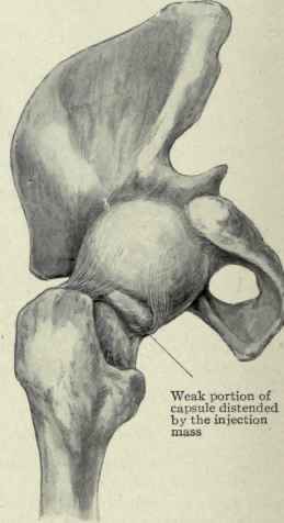 Fig. 511.   Hip joint distended with wax; the capsule ends posteriorly half way down the neck and is seen distended by the injection material protruding between the two arms of the ischiofemoral ligament.