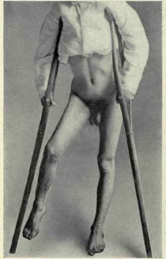 Fig. 518.   Thyroid luxation on the anterior plane. The thigh is flexed and abducted; the toes pointing forward. (From a photograph by Dr. Chas. F.Nassau).