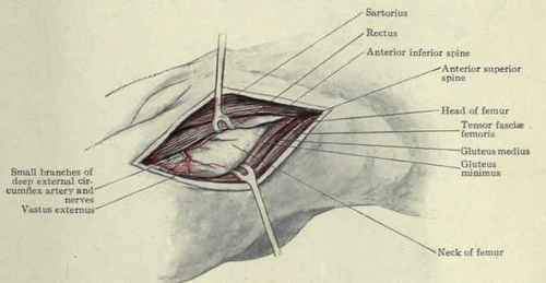 Fig. 528.   Anterior operation on the hip joint.