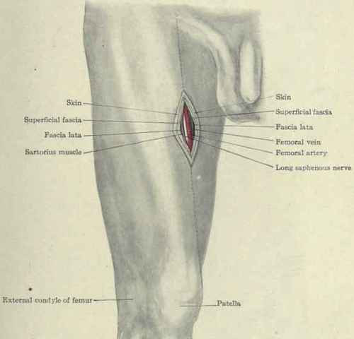 Fig. 534.   Ligation of the femoral artery at the apex of Scarpa's triangle.
