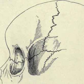 Fig. 54.   Frontal region of a child's skull.