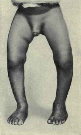Fig. 556.   Bow legs.
