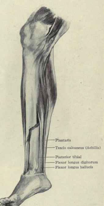 Fig. 564.   Fracture of the tibia with displacement of the upper fragment forward and lower fragment backward and upward.