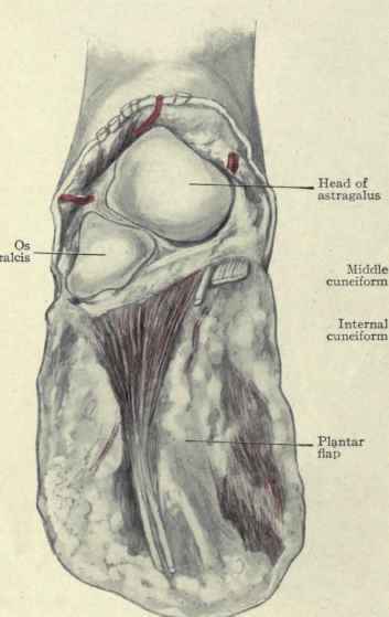 Fig. 592.   Chopart's midtarsal amputation of the foot.