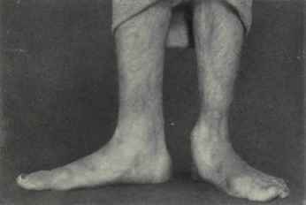 Fig. 597.   Flat foot.