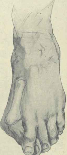 Fig. 601.   Hallux valgus, showing the position of the bones.