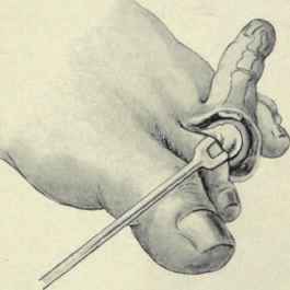 Fig. 604.   Amputation of a toe at the metatarsophalangeal joint, with lateral flaps, showing method of disarticulating.