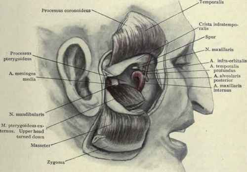 Fig. 67.   Operating through the pterygoid fossa. The skin with the zygoma and masseter have been turned down. The coronoid process is divided and turned up. The upper head of the external pterygoid has been detached and turned down. The maxillary nerve is in front of the pterygoid plate (processus pterygoideus) and the mandibular nerve and middle meningeal artery just behind it.