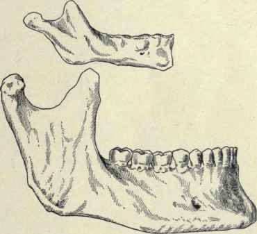 Fig. 71.   Lower jaw of child and adult, showing the mental foramen.