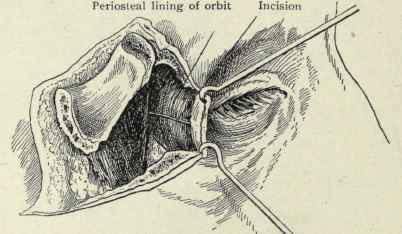 Fig. 91.   The rim of the orbit has been divided and the piece of the bone turned outward; an incision is then made through the periosteal lining. (Kronlein's operation for obtaining access to the retrobulbar region).