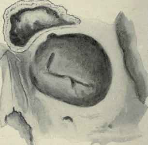 Figs. 123 and 124.   Two views of the frontal sinus, showing variation in size in different individuals. The anterior wall has been cut away to expose the interior of the sinus.