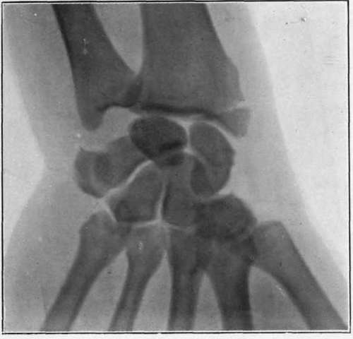 Fig. I.   ' Motor sprain ' of wrist. Separation of styloid process of radius, caused by attempt at starting the engine of a motor car. Fracture discovered by use of x rays some time after the injury.