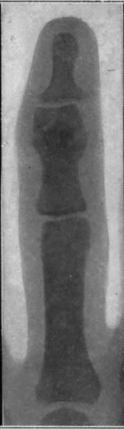 Fig. II   Fracture of head of phalanx of finger shown by x rays after two months' treatment for sprain.