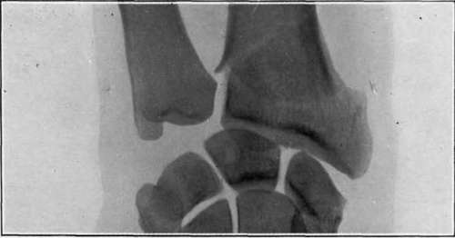 Fig. II.   'Motor sprain.' Comminuted fracture of lower end of radius, caused in the same way as fig. I. There was no deformity; the fracture had not been detected until shown by x rays three months after the injury.