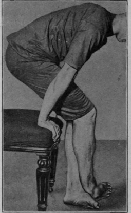 Fig. 113.   The third sitting exercise in the re education of walking. Continuation of the clawing exercise. Note the body weight is still partly supported by the arms