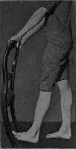 Fig. 115.   To show how the patient takes the first quarter of a full step. The left leg has been swung to and fro and is then checked in the position shown