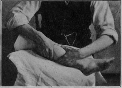 Fig. 12.   To illustrate picking up of the calf muscles. The flexion of knee combined with plantar flexion of ankle ensures relaxation. Adequate lateral support for the knee is essential in this position. If the masseur stands at the end of the bed, the foot should rest with its plantar surface upon it, the knee being flexed to nearly a right angle (cf. Fig. 15, p. 60)
