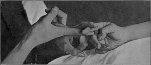 Fig. 144.   To show the grip for rolling the flesh of a digit to loosen the tissues when a nerve has been caught in the scar