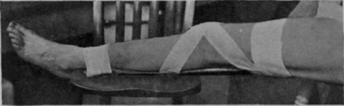 Fig. 160.   To show the application of a straight posterior splint to the back of the leg so as to avoid undue pressure on the vastus internus