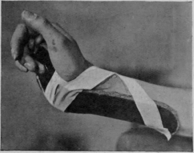 Fig. 161.   A short cock up splint applied so as to exert as little obstruction as possible to the return of the blood in the veins on the back of the hand