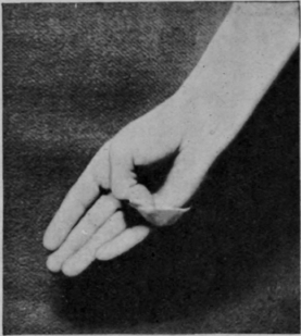 Fig. 162. To show how the opponens pollicis can be prevented from stretching by the application of adhesive plaster. If desired the nail need not be covered, as the plaster can be split and made to encircle the distal phalanx
