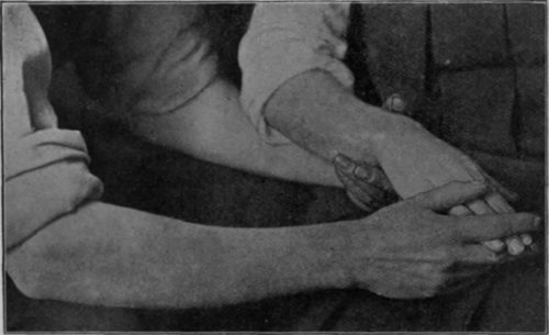 Fig. 17.   To show extension of fingers with flexion of the wrist