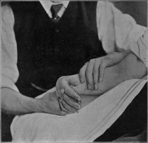 Fig. 19.   Showing full flexion of the wrist. Note the rotation of the forearm as compared with Fig. 18, and also the unaided extension of the fingers