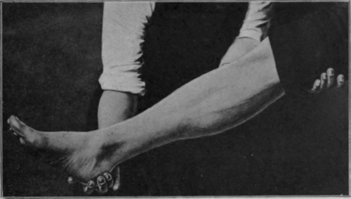 Fig. 2.   The same as in Fig. I, the limb being supported only at the heel. The long axis of the oval becomes vertical