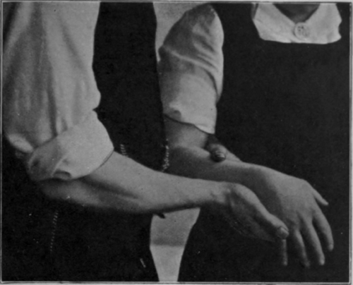 Fig. 20.   To show ulnar deviation of wrist