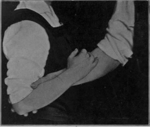 Fig. 25.   To show position for all early relaxed movements of elbow or shoulder. Note the combined flexion of elbow, extension of shoulder and supination of wrist